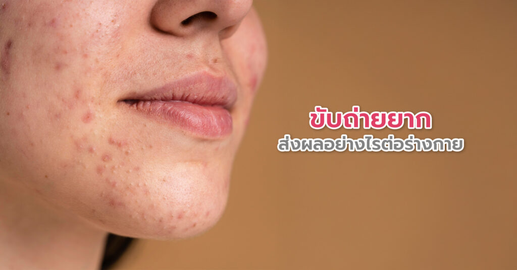 สาเหตุของอาการขับถ่ายยาก การรับประทานอาหารที่มีไฟเบอร์ไม่เพียงพอ
ไฟเบอร์หรือใยอาหาร (Dietary Fiber) เป็นองค์ประกอบสำคัญที่ช่วยให้ลำไส้บีบตัวและขับของเสียได้ตามจังหวะ สำหรับผู้ใหญ่หากร่างกายได้รับไฟเบอร์ต่ำกว่า 20 กรัมต่อวัน จะทำให้เนื้ออุจจาระแข็ง